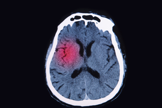 What Happens When a Loved One Suffers a Traumatic Brain Injury After an Auto Accident?